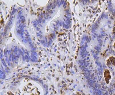 Immunohistochemistry-Paraffin: Histone H2AE [Hydroxy Tyr39] Antibody (SR4-17) [NBP2-67337] - Analysis of paraffin-embedded human colon cancer tissue using anti-Histone H2A(hydroxyl Y39) antibody. Counter stained with hematoxylin.