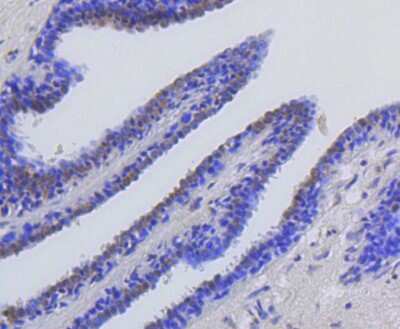Immunohistochemistry-Paraffin: Histone H2AE [ac Lys9] Antibody (SR4-15) [NBP2-67336] - Analysis of paraffin-embedded human breast carcinoma tissue using anti-Histone H2A(acetyl K9) antibody. Counter stained with hematoxylin.