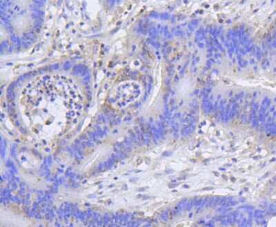 Immunohistochemistry-Paraffin: Histone H2AE [ac Lys9] Antibody (SR4-15) [NBP2-67336] - Analysis of paraffin-embedded human colon cancer tissue using anti-Histone H2A(acetyl K9) antibody. Counter stained with hematoxylin.