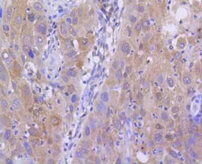 Immunohistochemistry-Paraffin: Histone H2AE [ac Lys9] Antibody (SR4-15) [NBP2-67336] - Analysis of paraffin-embedded human lung carcinoma tissue using anti-Histone H2A(acetyl K9) antibody. Counter stained with hematoxylin.