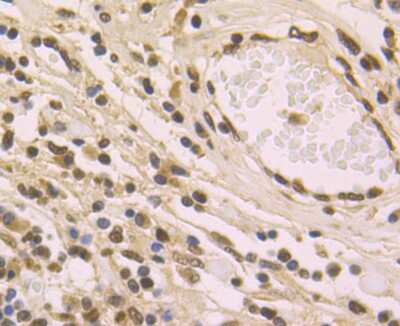 Immunohistochemistry-Paraffin: Histone H2AY/macroH2A.1 Antibody (JU22-83) [NBP2-75523] - Analysis of paraffin-embedded human lung cancer tissue using anti-macroH2A.1 antibody. Counter stained with hematoxylin.