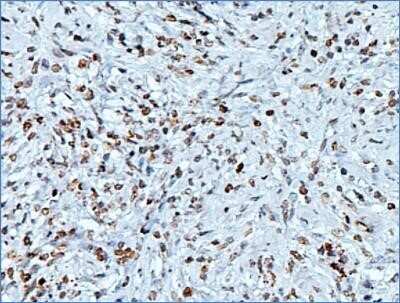 Immunohistochemistry: Histone H3 Antibody (1B1-B2) - Azide and BSA Free [NBP2-80770] - Analysis of Histone H3 in human breast cancer using DAB with hematoxylin counterstain. Image from the standard format of this antibody.