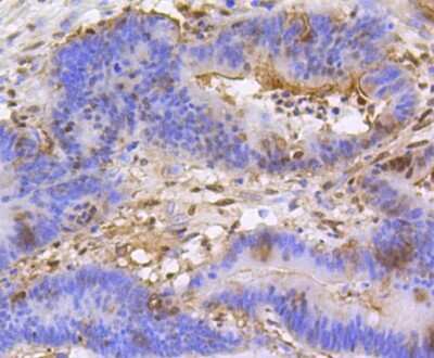 Immunohistochemistry-Paraffin: Histone H3 [Trimethyl Lys79] Antibody (SR42-06) [NBP2-67343] - Analysis of paraffin-embedded human colon cancer tissue using anti-Histone H3(mono+di+tri methyl K79) antibody. Counter stained with hematoxylin.
