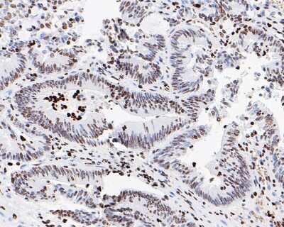 Immunohistochemistry-Paraffin: Histone H3 [ac Lys56] Antibody (SU30-10) [NBP2-67489] - Analysis of paraffin-embedded human colon carcinoma tissue with Rabbit anti-Histone H3 [ac LysK56) antibody washed with ddH2O and PBS, and then probed with the primary antibody  at 1/200 dilution for 1 hour at room temperature. The detection was performed using an HRP conjugated compact polymer system. DAB was used as the chromogen. Tissues were counterstained with hematoxylin and mounted with DPX.