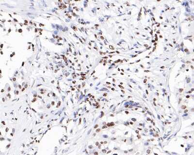 Immunohistochemistry-Paraffin: Histone H3 [ac Lys56] Antibody (SU30-10) [NBP2-67489] - Analysis of paraffin-embedded human breast carcinoma tissue with Rabbit anti-Histone H3 [ac LysK56] antibody washed with ddH2O and PBS, and then probed with the primary antibody at 1/200 dilution for 1 hour at room temperature. The detection was performed using an HRP conjugated compact polymer system. DAB was used as the chromogen. Tissues were counterstained with hematoxylin and mounted with DPX.