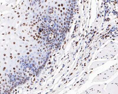 Immunohistochemistry-Paraffin: Histone H3 [ac Lys56] Antibody (SU30-10) [NBP2-67489] - Analysis of paraffin-embedded human esophageal carcinoma tissue with Rabbit anti-Histone H3 [ac LysK56] antibody washed with ddH2O and PBS, and then probed with the primary antibody  at 1/200 dilution for 1 hour at room temperature. The detection was performed using an HRP conjugated compact polymer system. DAB was used as the chromogen. Tissues were counterstained with hematoxylin and mounted with DPX.