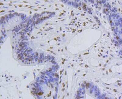 Immunohistochemistry-Paraffin: Histone H4 [ac Lys5] Antibody (SR31-07) [NBP2-67342] - Analysis of paraffin-embedded human colon cancer tissue using anti-Histone H4(acetyl K5) antibody. Counter stained with hematoxylin.