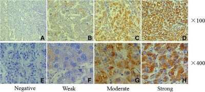 Immunohistochemistry: Hornerin Antibody [NBP1-80807] - Hornerin overpression in human HCC tumor tissues. Immunohistochemistry of Hornerin expression in hepatocellular carcinoma (HCC) tissues. Hornerin expression in the cytoplasm and membrane is scored as negative (a, e), weak (b, f), moderate (c, g), and strong (d, h). Original magnification, x 100 (a-d); x 400 (e-h) Image collected and cropped by CiteAb from the following publication (//bmccancer.biomedcentral.com/articles/10.1186/s12885-018-4719-5), licensed under a CC-BY license.