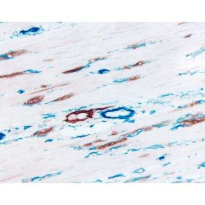 Immunohistochemistry: Horse anti-Mouse, Rabbit IgG ImmPRESS(TM) Universal Secondary Antibody [HRP Polymer] [MP-7500-NB] - Colon (double label): M2A Antigen (m), ImmPRESS Universal Reagent, Vector NovaRED substrate (red); CD34 (m), VECTASTAIN Universal ABC-AP Kit, Vector Blue substrate (blue).