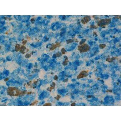 Immunohistochemistry: Horse anti-Rabbit IgG ImmPRESS(TM) Secondary Antibody [AP Polymer] [MP-5401-NB] - Melanoma: Anti-Vimentin (rabbit mab), ImmPRESS-AP Anti-Rabbit IgG, Vector Blue Substrate (blue).