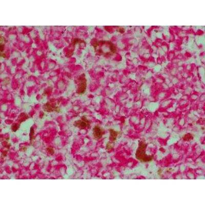 Immunohistochemistry: Horse anti-Rabbit IgG ImmPRESS(TM) Secondary Antibody [AP Polymer] [MP-5401-NB] - Melanoma: Anti-Vimentin (rabbit mab), ImmPRESS-AP Anti-Rabbit IgG, ImmPACT Vector Red Substrate (red).