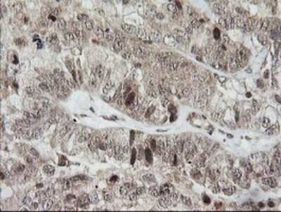 Immunohistochemistry: Host cell factor C2 Antibody (OTI5H9) - Azide and BSA Free [NBP2-71862] - Analysis of Adenocarcinoma of Human ovary tissue.