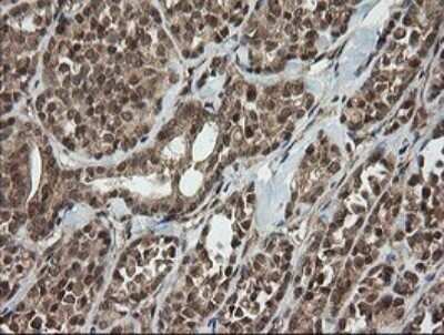Immunohistochemistry: Host cell factor C2 Antibody (OTI5H9) - Azide and BSA Free [NBP2-71862] - Analysis of Carcinoma of Human thyroid tissue.