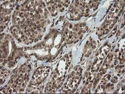 Immunohistochemistry: Host cell factor C2 Antibody (OTI5H9) [NBP2-45733] - Analysis of Carcinoma of Human thyroid tissue.