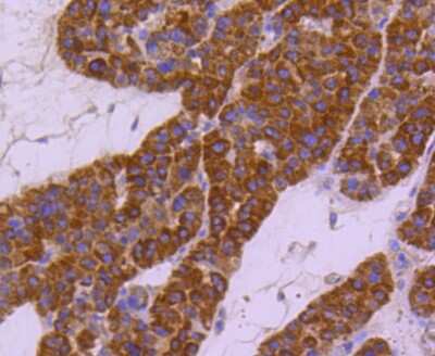 Immunohistochemistry-Paraffin: HspA4 Antibody (SD0861) [NBP2-67817] - Analysis of paraffin-embedded human liver cancer tissue using anti-HSPA4 antibody. Counter stained with hematoxylin.