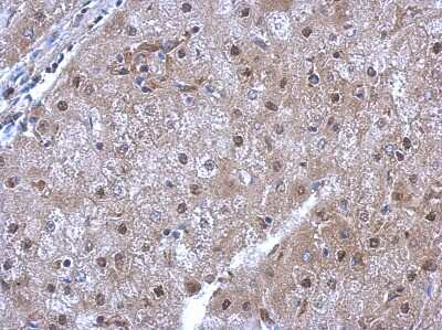 Immunohistochemistry-Paraffin: HspA6 Antibody [NBP2-16899] - Human hepatoma, using HSPA6  antibody at 1:500 dilution.  Antigen Retrieval: Trilogy™ (EDTA based, pH 8.0) buffer, 15min.