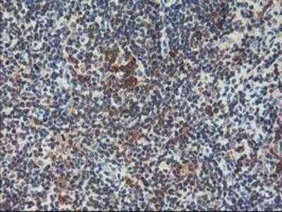 Immunohistochemistry: HspBP1 Antibody (OTI1D5) - Azide and BSA Free [NBP2-71761] - Staining of paraffin-embedded Human lymphoma tissue using anti-HspBP1 mouse monoclonal antibody.