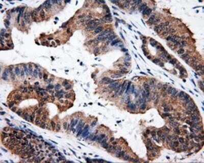 Immunohistochemistry-Paraffin: HuR/ELAVL1 Antibody (14F4) [NBP2-02287] - Staining of paraffin-embedded Adenocarcinoma of colon tissue using anti-HuR/ELAVL1mouse monoclonal antibody.