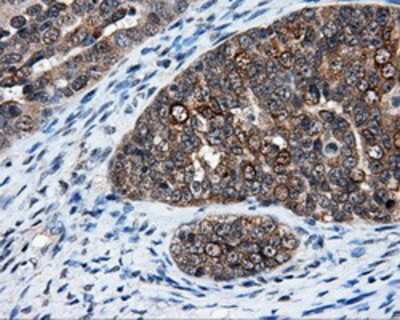 Immunohistochemistry-Paraffin: HuR/ELAVL1 Antibody (14F4) [NBP2-02287] - Staining of paraffin-embedded Adenocarcinoma of ovary tissue using anti-HuR/ELAVL1 mouse monoclonal antibody.