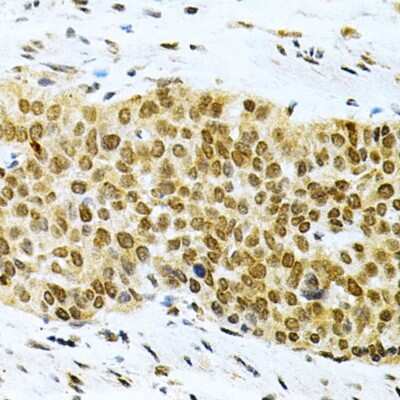 Immunohistochemistry-Paraffin: HuR/ELAVL1 Antibody [NBP3-03449] - Paraffin-embedded human esophageal cancer using HuR/ELAVL1 antibody at dilution of 1:200 (40x lens).