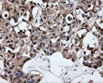 Immunohistochemistry: HuR/ELAVL1 Antibody (OTI14F4) - Azide and BSA Free [NBP2-70635] - Staining of paraffin-embedded Adenocarcinoma of breast tissue using anti-HuR/ELAVL1 mouse monoclonal antibody.