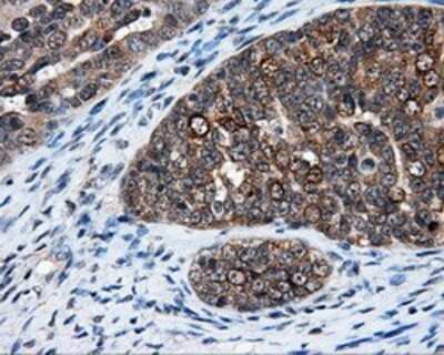 Immunohistochemistry: HuR/ELAVL1 Antibody (OTI14F4) - Azide and BSA Free [NBP2-70635] - Staining of paraffin-embedded Adenocarcinoma of ovary tissue using anti-HuR/ELAVL1 mouse monoclonal antibody.