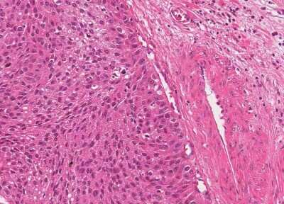 Immunohistochemistry-Paraffin: Human Bladder Tissue MicroArray (Cancer) [NBP3-11846] - 1. Urothelial carcincoma