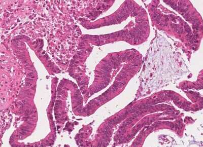 Immunohistochemistry-Paraffin: Human Bladder Tissue MicroArray (Cancer) [NBP3-11846] - 2. Mucinous adenocarcinoma, urachal origin