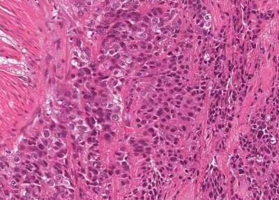 Immunohistochemistry-Paraffin: Human Bladder Tissue MicroArray (Cancer) [NBP3-11846] - 3. Urothelial carcincoma