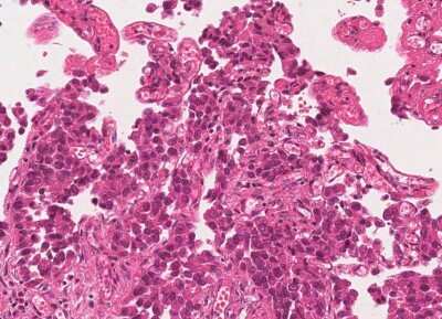 Immunohistochemistry-Paraffin: Human Bladder Tissue MicroArray (Cancer) [NBP3-11846] - 4. Urothelial carcincoma