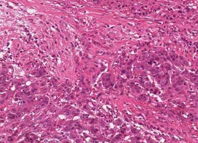 Immunohistochemistry-Paraffin: Human Bladder Tissue MicroArray (Cancer) [NBP3-11846] - 5. Urothelial carcincoma