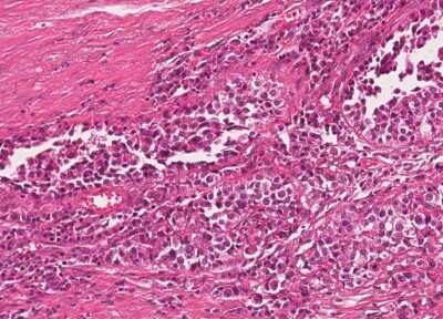 Immunohistochemistry-Paraffin: Human Bladder Tissue MicroArray (Cancer) [NBP3-11846] - 6. Urothelial carcincoma