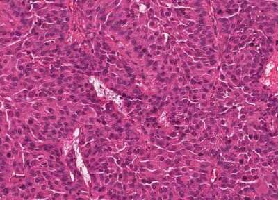 Immunohistochemistry-Paraffin: Human Bladder Tissue MicroArray (Cancer) [NBP3-11846] - 7. Urothelial carcincoma