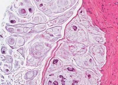 Immunohistochemistry-Paraffin: Human Bladder Tissue MicroArray (Cancer) [NBP3-11846] - 8. Mucinous adenocarcinom