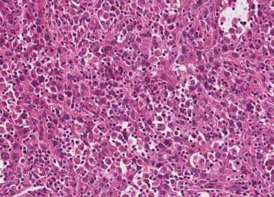 Immunohistochemistry-Paraffin: Human Bladder Tissue MicroArray (Cancer) [NBP3-11846] - 9. Urothelial carcincoma