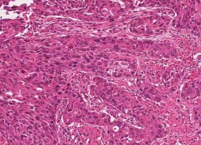 Immunohistochemistry-Paraffin: Human Bladder Tissue MicroArray (Cancer) [NBP3-11846] - 10. Squamous cell carcinoma