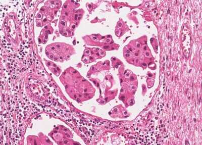 Immunohistochemistry-Paraffin: Human Bladder Tissue MicroArray (Cancer) [NBP3-11846] - 11. Urothelial carcincoma