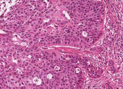 Immunohistochemistry-Paraffin: Human Bladder Tissue MicroArray (Cancer) [NBP3-11846] - 12. Urothelial carcincoma