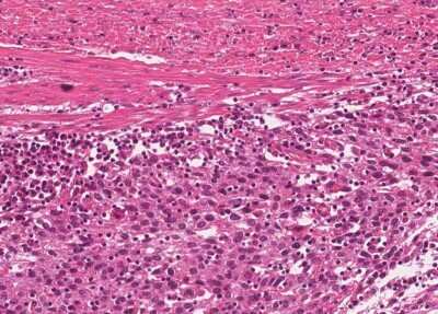 Immunohistochemistry-Paraffin: Human Bladder Tissue MicroArray (Cancer) [NBP3-11846] - 13. Urothelial carcincoma