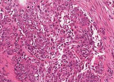 Immunohistochemistry-Paraffin: Human Bladder Tissue MicroArray (Cancer) [NBP3-11846] - 14. Urothelial carcincoma