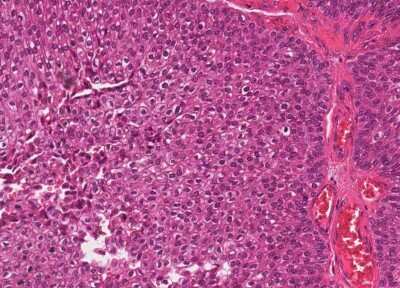 Immunohistochemistry-Paraffin: Human Bladder Tissue MicroArray (Cancer) [NBP3-11846] - 15. Urothelial carcincoma