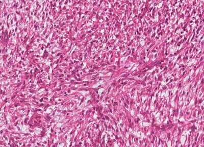 Immunohistochemistry-Paraffin: Human Bladder Tissue MicroArray (Cancer) [NBP3-11846] - 16. Inflammatory myofibroblastic tumor