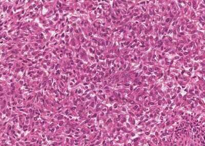 Immunohistochemistry-Paraffin: Human Bladder Tissue MicroArray (Cancer) [NBP3-11846] - 17. Urothelial carcincoma