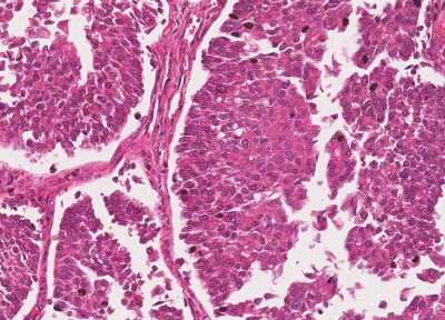 Immunohistochemistry-Paraffin: Human Bladder Tissue MicroArray (Cancer) [NBP3-11846] - 18. Urothelial carcincoma