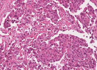 Immunohistochemistry-Paraffin: Human Bladder Tissue MicroArray (Cancer) [NBP3-11846] - 19. Urothelial carcincoma