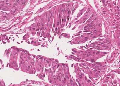 Immunohistochemistry-Paraffin: Human Bladder Tissue MicroArray (Cancer) [NBP3-11846] - 20. Urothelial carcincoma