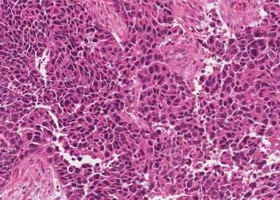 Immunohistochemistry-Paraffin: Human Bladder Tissue MicroArray (Cancer) [NBP3-11846] - 22. Urothelial carcincoma