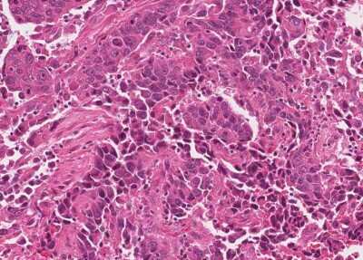 Immunohistochemistry-Paraffin: Human Bladder Tissue MicroArray (Cancer) [NBP3-11846] - 23. Urothelial carcincoma