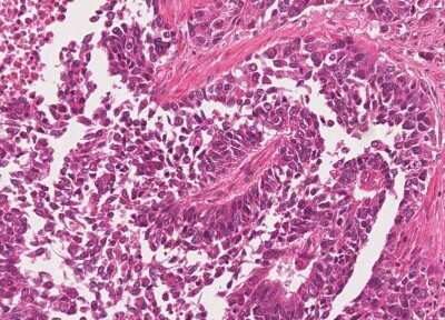 Immunohistochemistry-Paraffin: Human Bladder Tissue MicroArray (Cancer) [NBP3-11846] - 24. Urothelial carcincoma