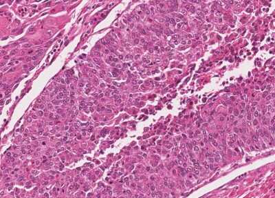 Immunohistochemistry-Paraffin: Human Bladder Tissue MicroArray (Cancer) [NBP3-11846] - 25. Urothelial carcincoma